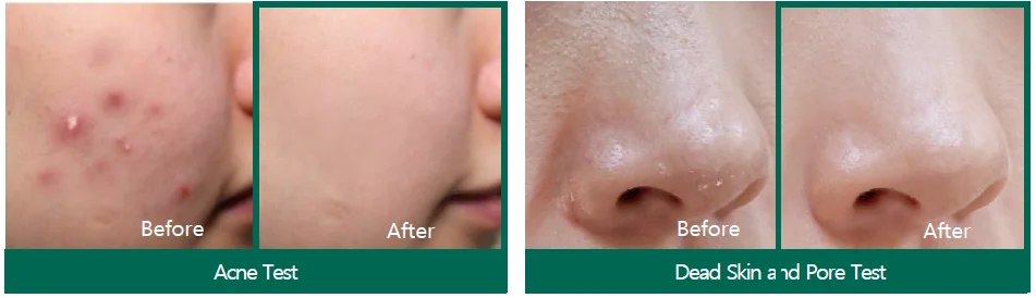 30 Days Miracle Serum AHA BHA PHA de chez Some By Mi - Photo avant après