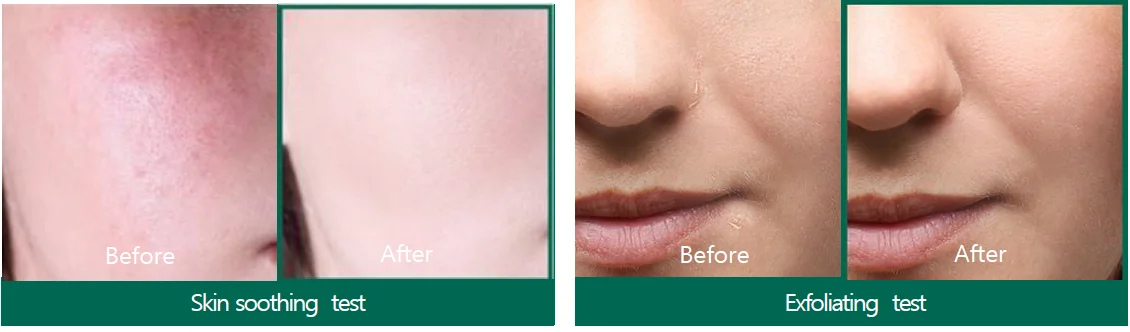 30 Days Miracle Cream AHA BHA PHA de chez Some By Mi - avant après