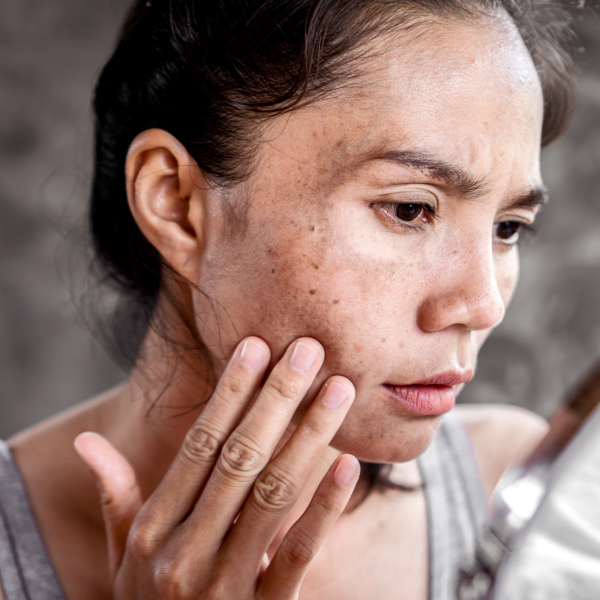 Femme avec des Taches brunes au visage