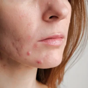 Meilleure routine Kbeauty contre l’acné hormonale